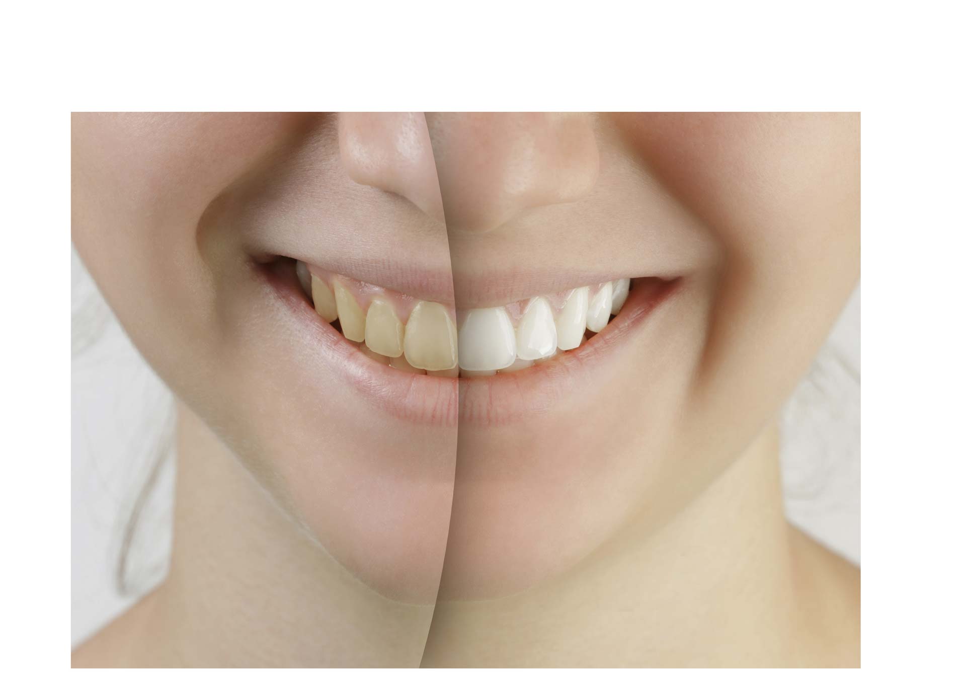 Con bicarbonato y papel aluminio se puede lograr un resultado tan prolijo como el de un dentista