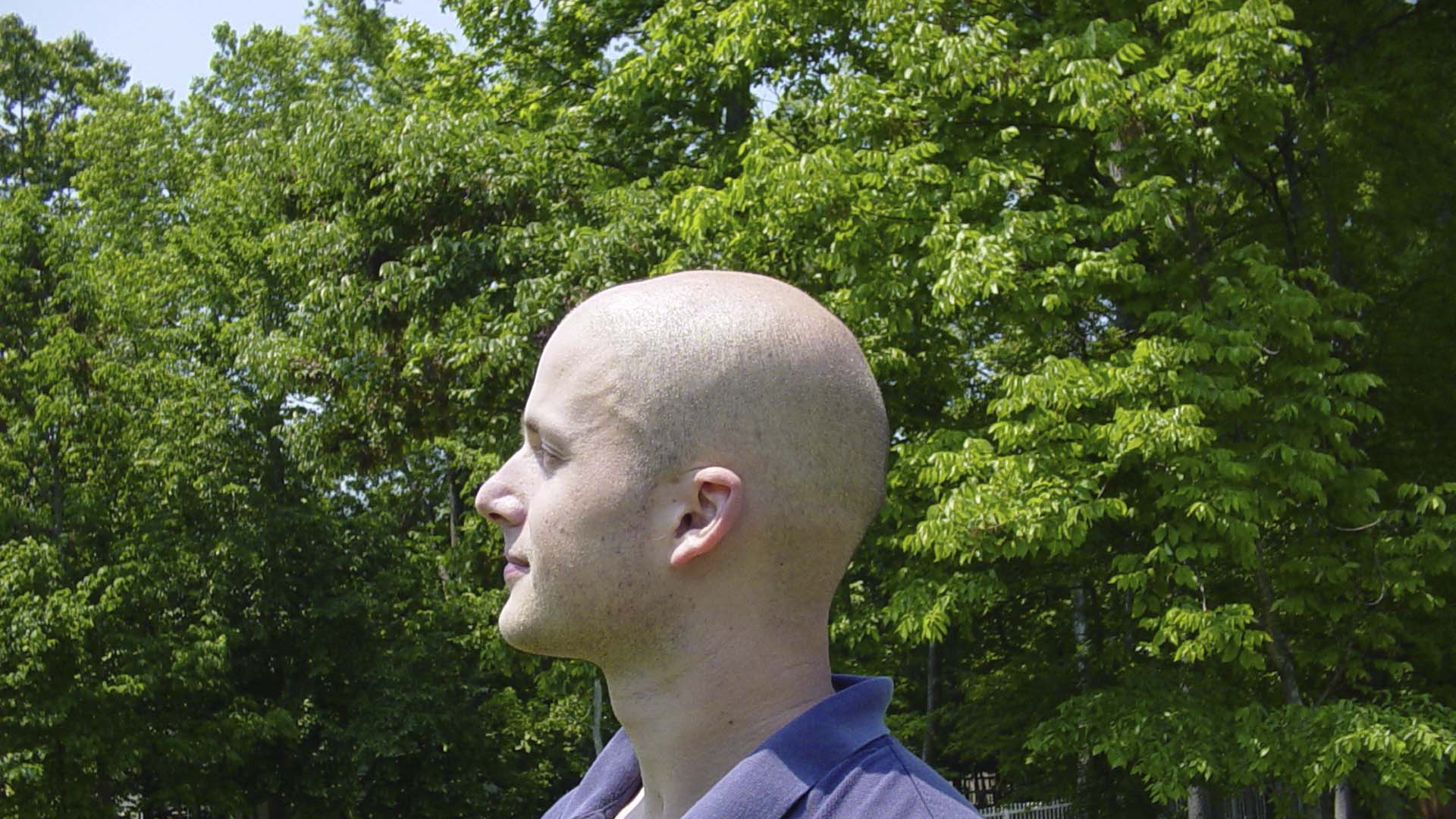 La mayoría de los casos de alopecias son causados por nosotros mismos, por lo que es importante llevar una vida calmada