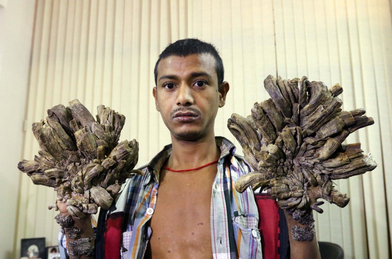 Abul Bajandar presenta en sus manos y pies verrugas en forma de cortezas