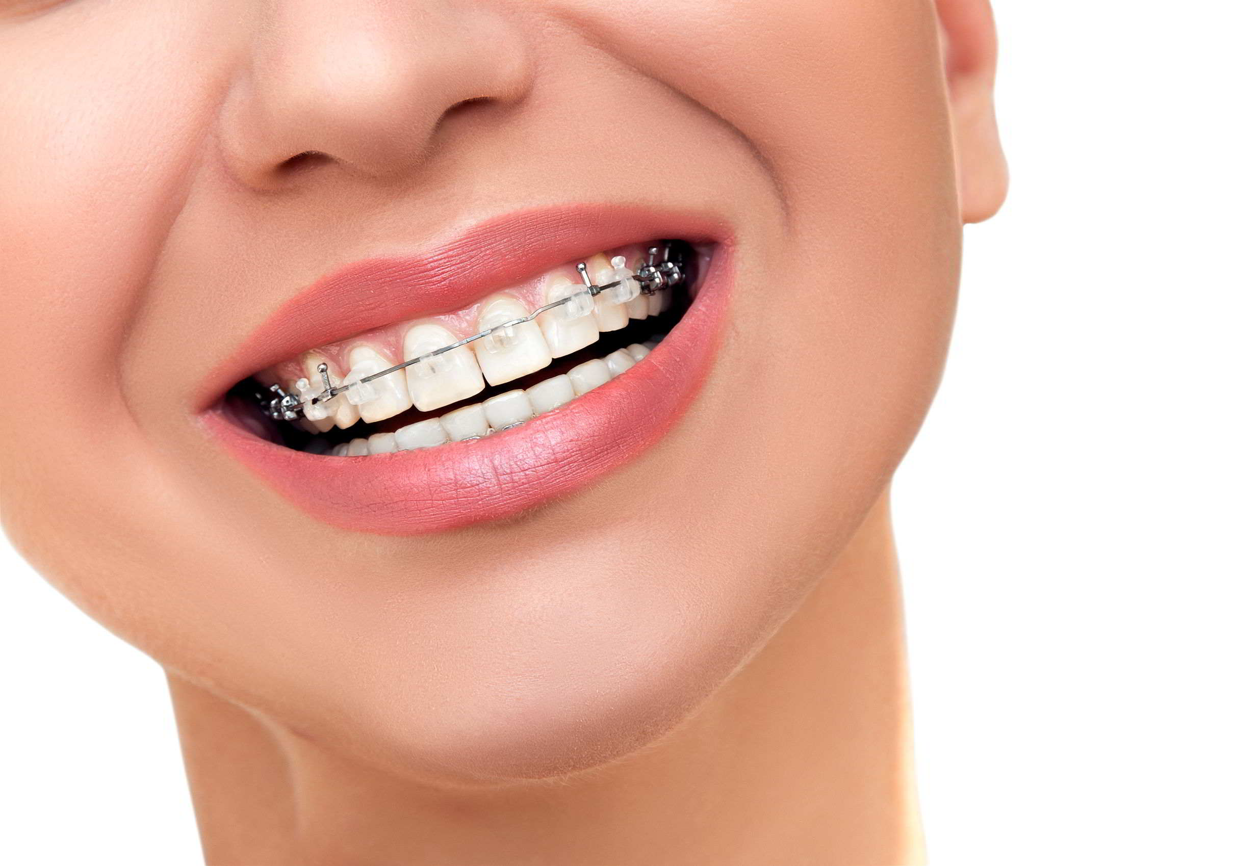 La culminación perfecta de un buen trabajo de Ortodoncia es el Blanqueamiento Dental