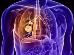 El Sumario - Investigación cambia el abordaje del tratamiento de metástasis cerebral respecto a cáncer de pulmón