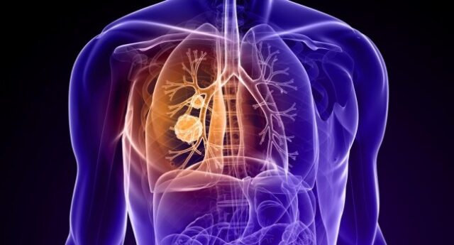 El Sumario - Investigación cambia el abordaje del tratamiento de metástasis cerebral respecto a cáncer de pulmón