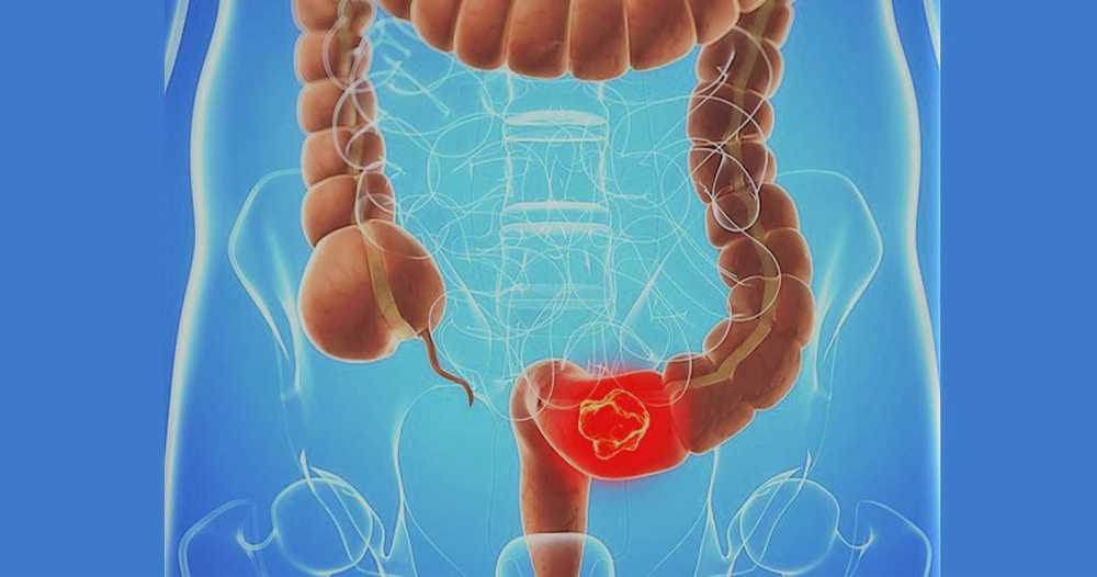 El Sumario - Niveles de vitamina D determinan riesgo de sufrir cáncer colorrectal