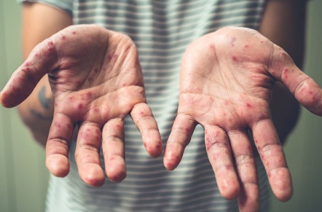 Monkeypox nuevo sínomas