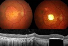 prótesis ocular