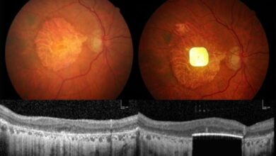 prótesis ocular