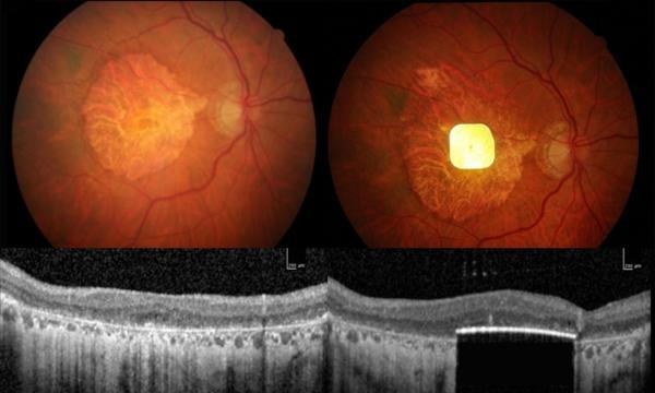 prótesis ocular