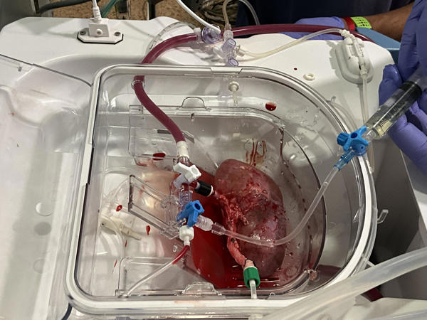 Trasplante riñón porcino